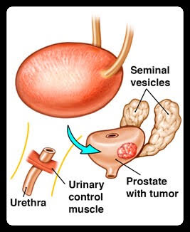 Prostate Enlargement Surgery