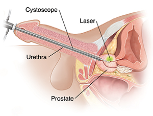 Laser Prostatectomy in Chennai