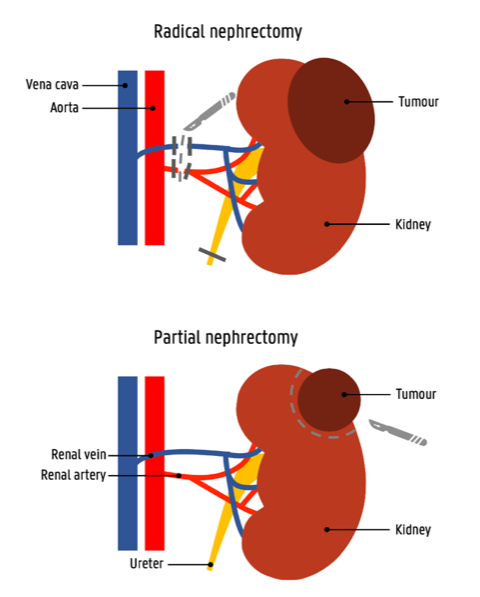 Kidney Tumor Treatment in Chennai