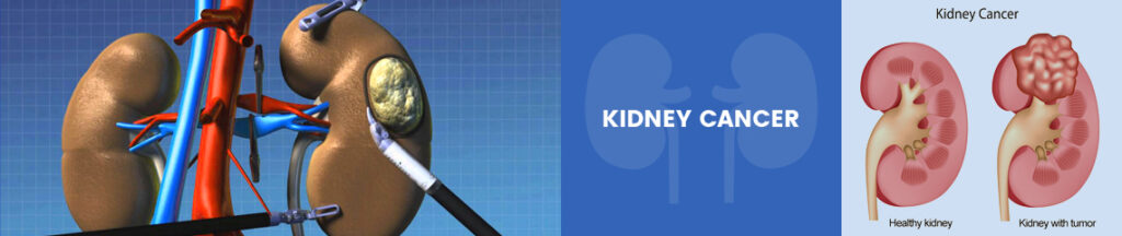 Top Kidney Tumor Treatment in Chennai