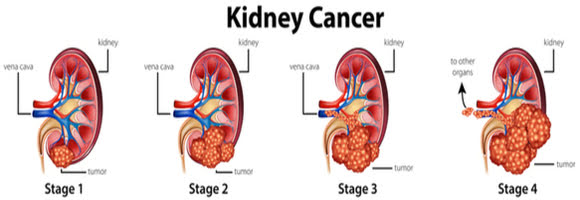 Kidney Cancer Treatment 