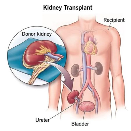 kidney transplant